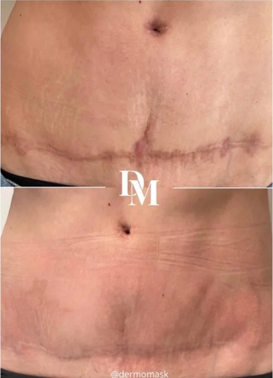 Cicatrice d'abdominoplastie de l'abdomen, photographie avant et après traitement