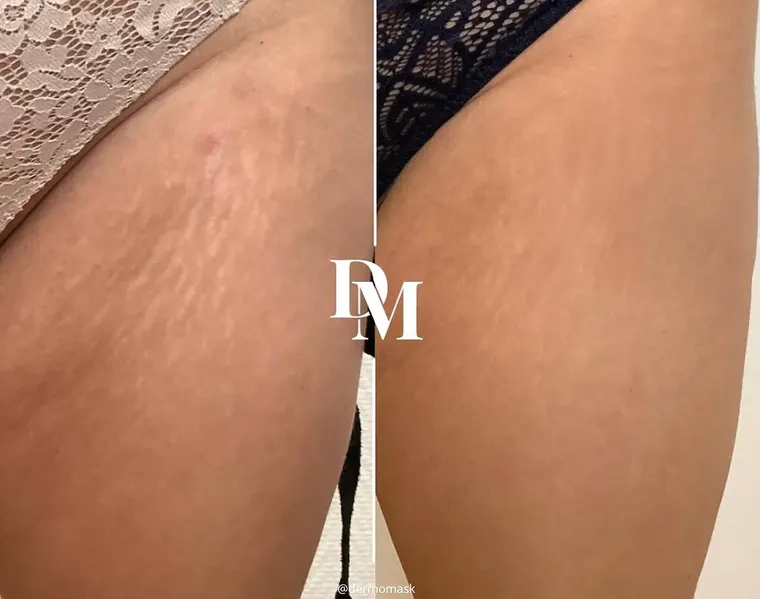 Vergetures de la cuisse, photographie avant et après traitement