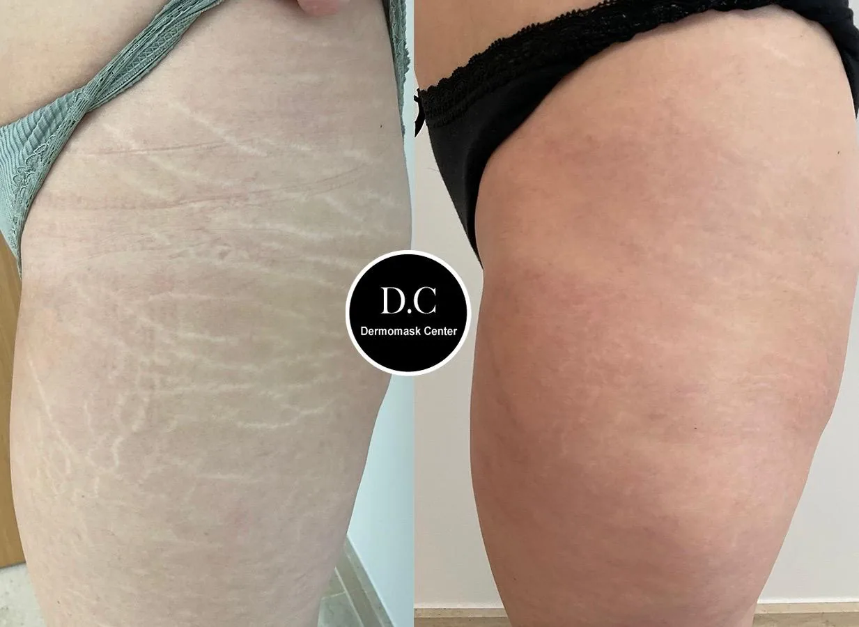 Vergetures blanches de la cuisse, photographie avant et après traitement