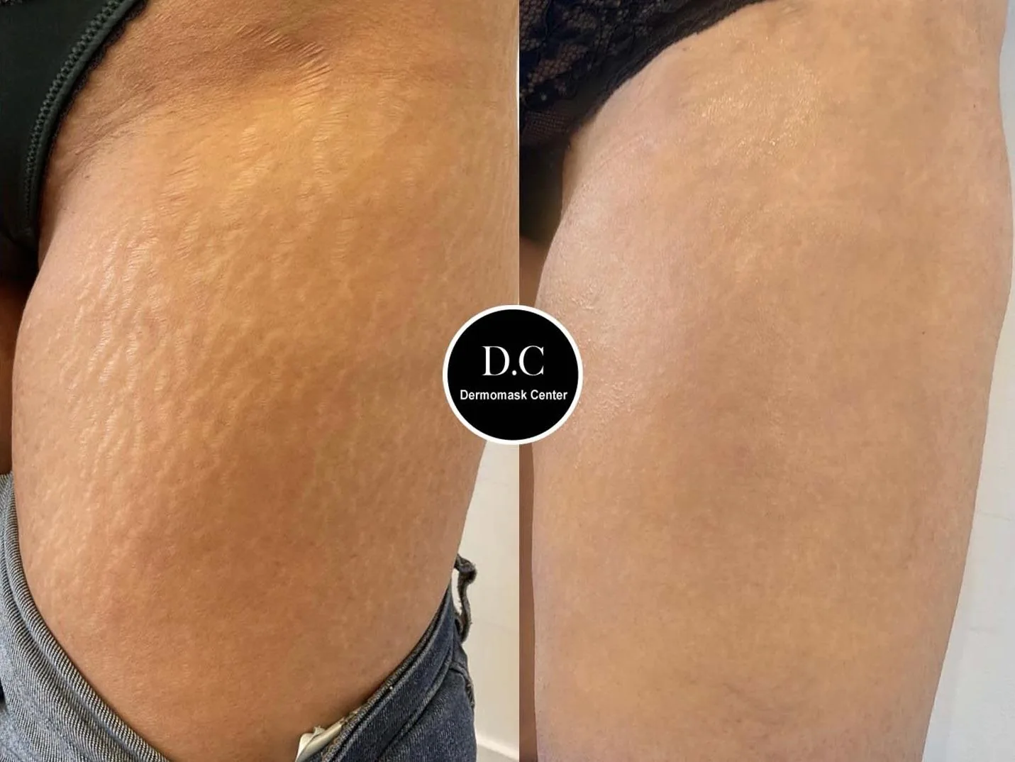 Vergetures étendues de la cuisse, photographie avant et après traitement
