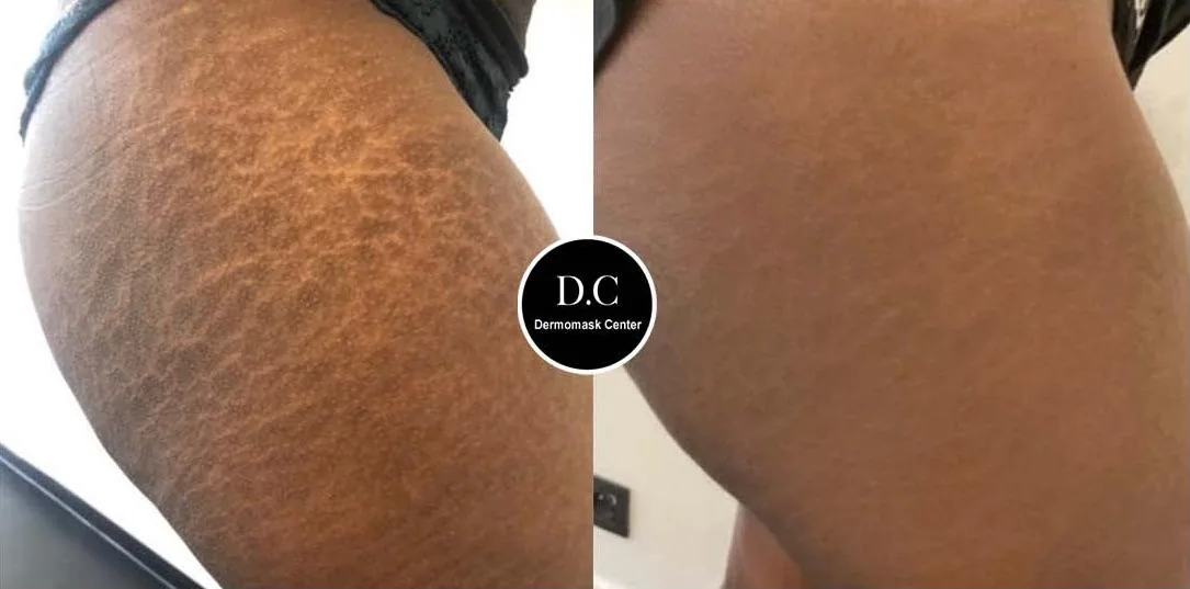 Vergetures étendues de la cuisse sur peau foncée, photographie avant et après traitement