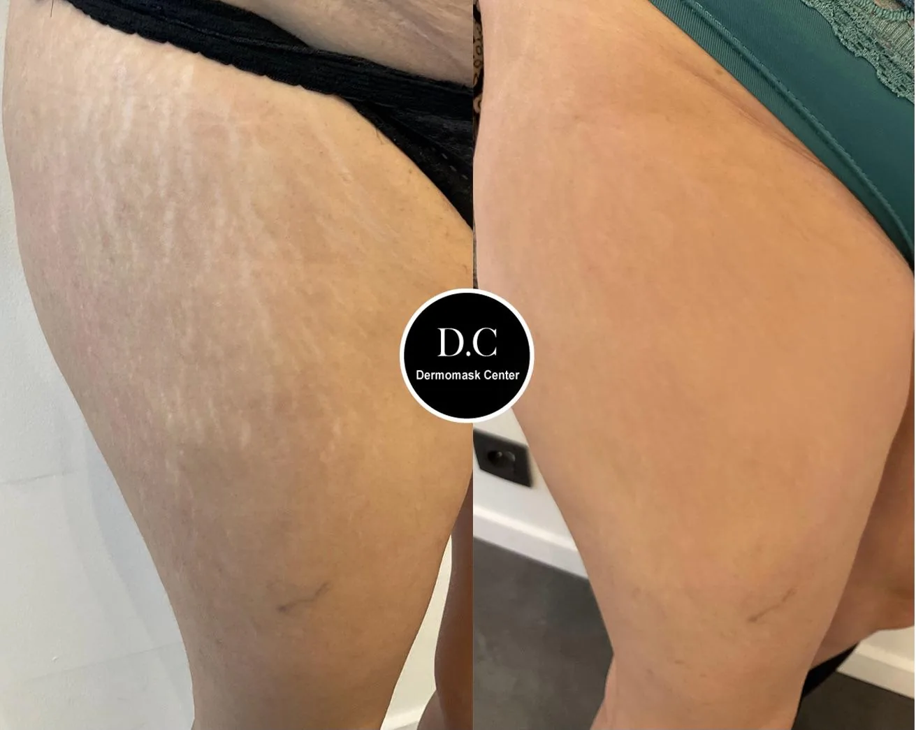 Vergetures blanches de la cuisse, photographie avant et après traitement