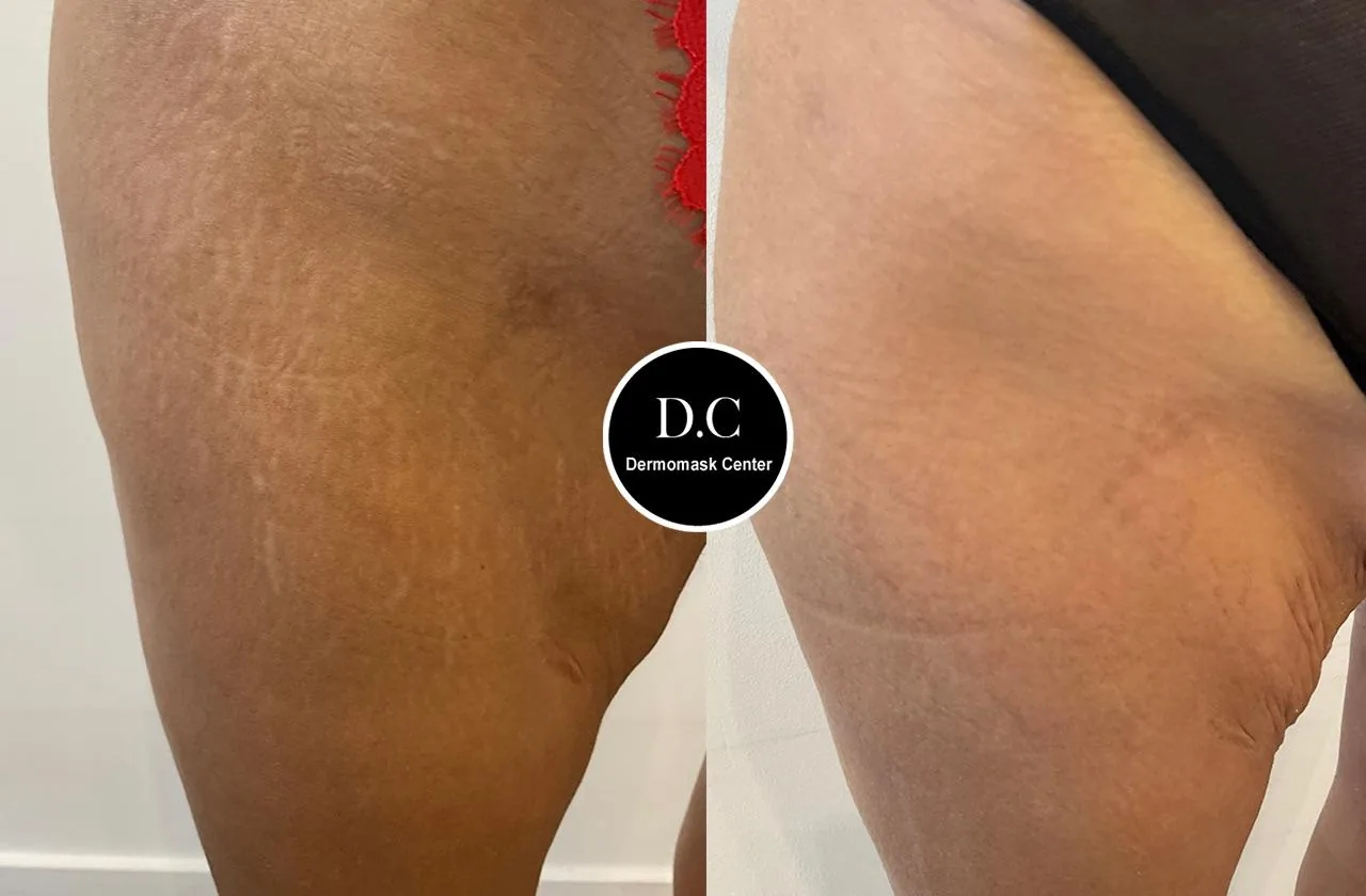 Vergetures de la cuisse, photographie avant et après traitement