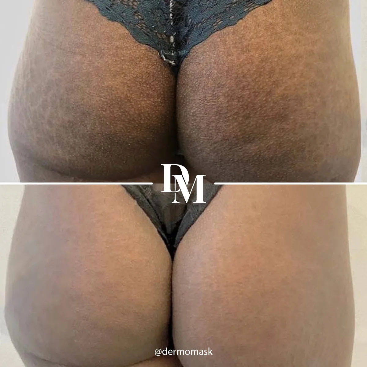 Vergetures des fesses sur peau noire, photographie avant et après traitement