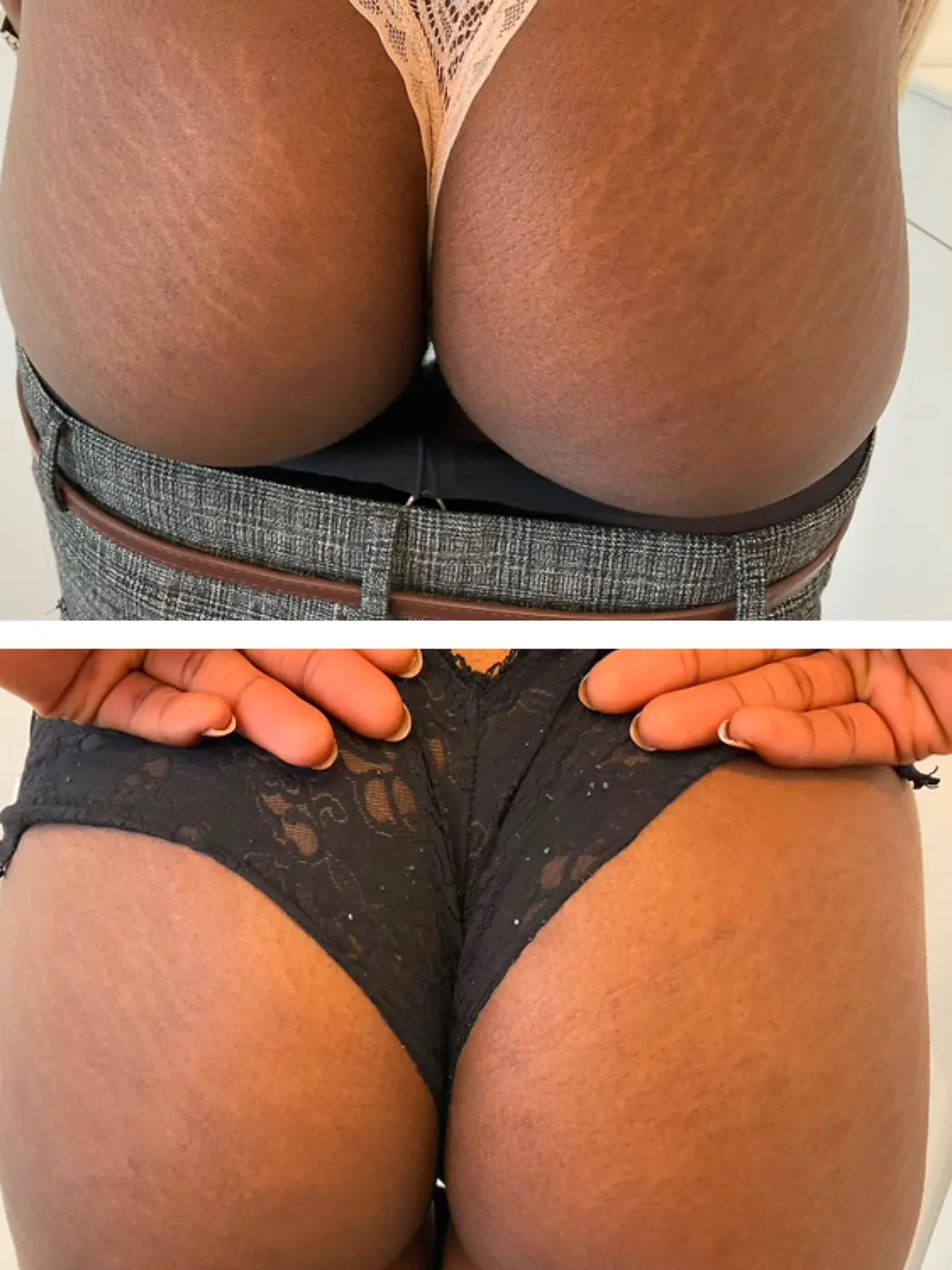 Vergetures des fesses sur peau foncée, photographie avant et après traitement