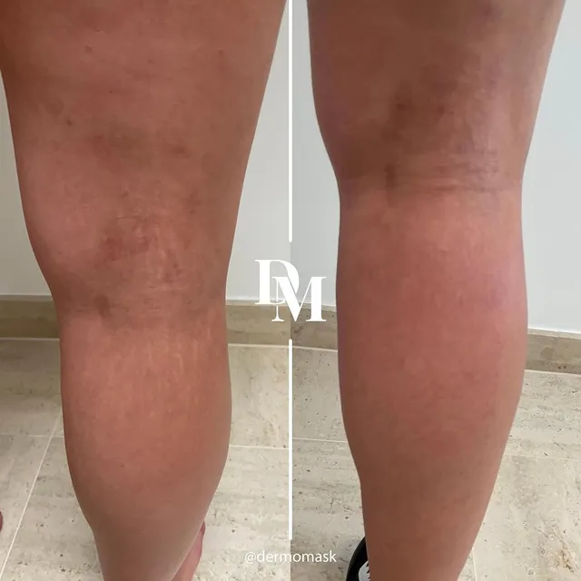 Vergetures des jambes, photographie avant et après traitement