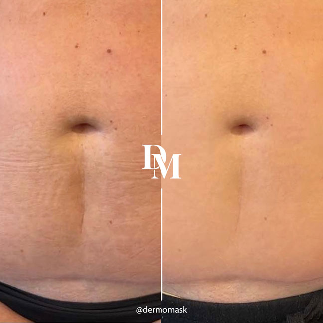Cicatrice verticale de l'abdomen, photographie avant et après traitement